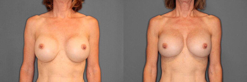 Breast Revision Before and After photo by Dr. Abigail Rodriguez in Houston, TX