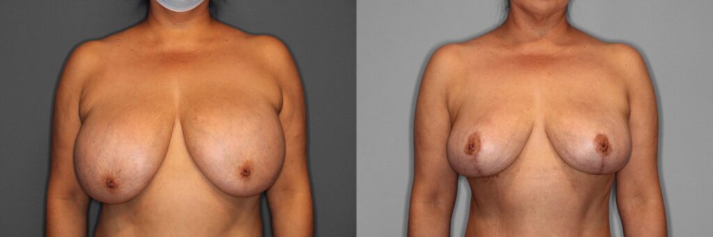 Explant Breast Lift Before and After photo by Dr. Abigail Rodriguez in Houston, TX