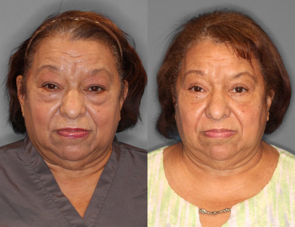 Eyelid Lift Before and After photo by Dr. Abigail Rodriguez in Houston, TX