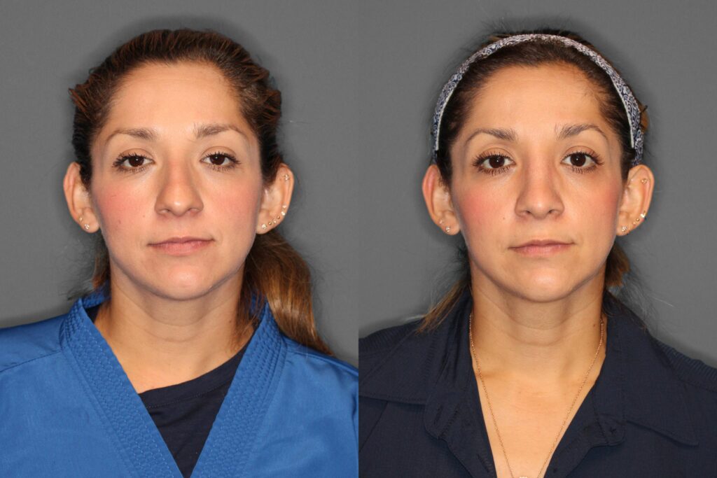 Rhinoplasty Before and After photo by Dr. Abigail Rodriguez in Houston, TX