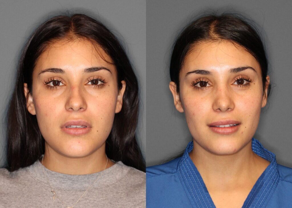 Rhinoplasty Before and After photo by Dr. Abigail Rodriguez in Houston, TX