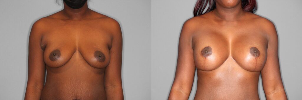 Breast Lift + Augmentation Before and After photo by Dr. Abigail Rodriguez in Houston, TX