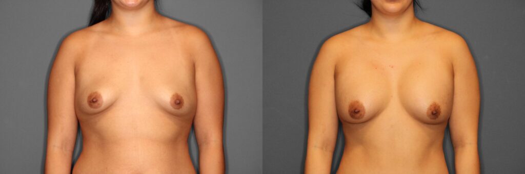 Breast Augmentation Before and After photo by Dr. Abigail Rodriguez in Houston, TX