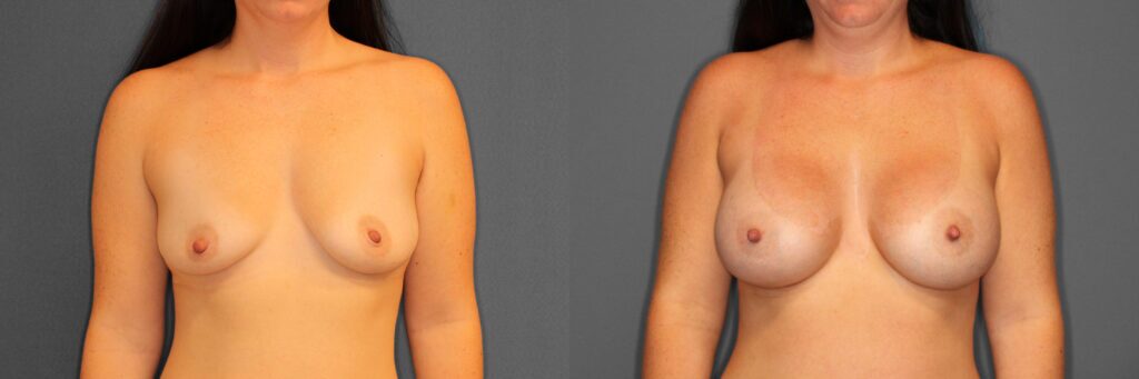 Breast Augmentation Before and After photo by Dr. Abigail Rodriguez in Houston, TX