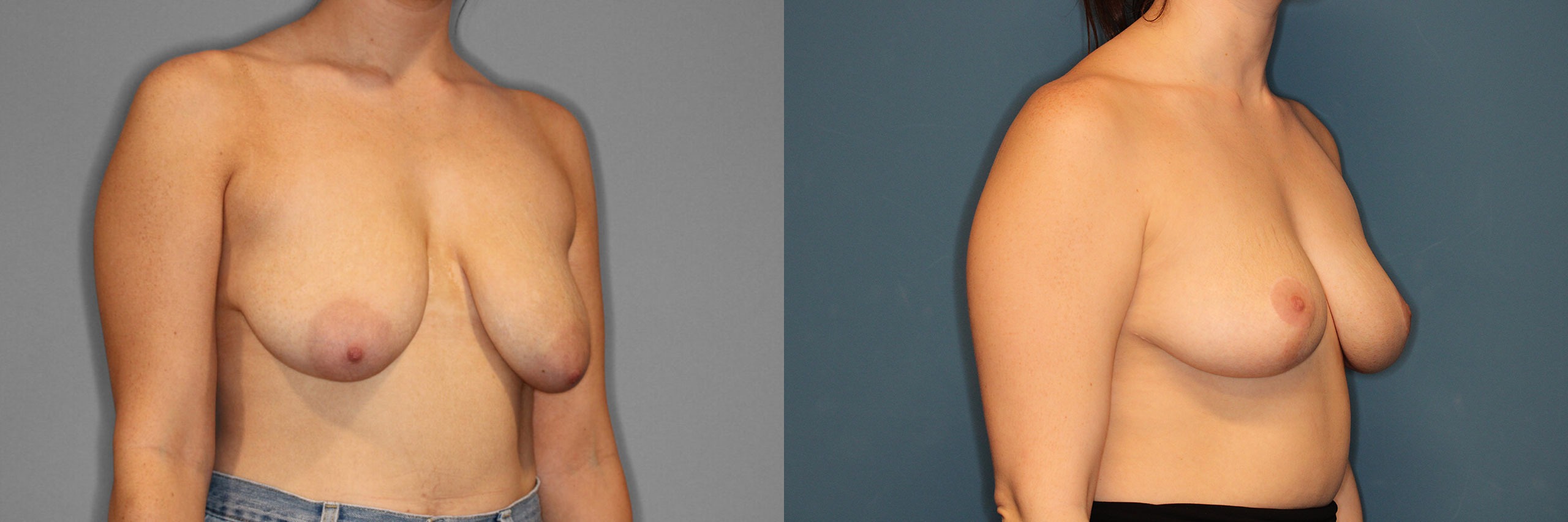 Breast Reduction Before and After photo by Dr. Abigail Rodriguez in Houston, TX