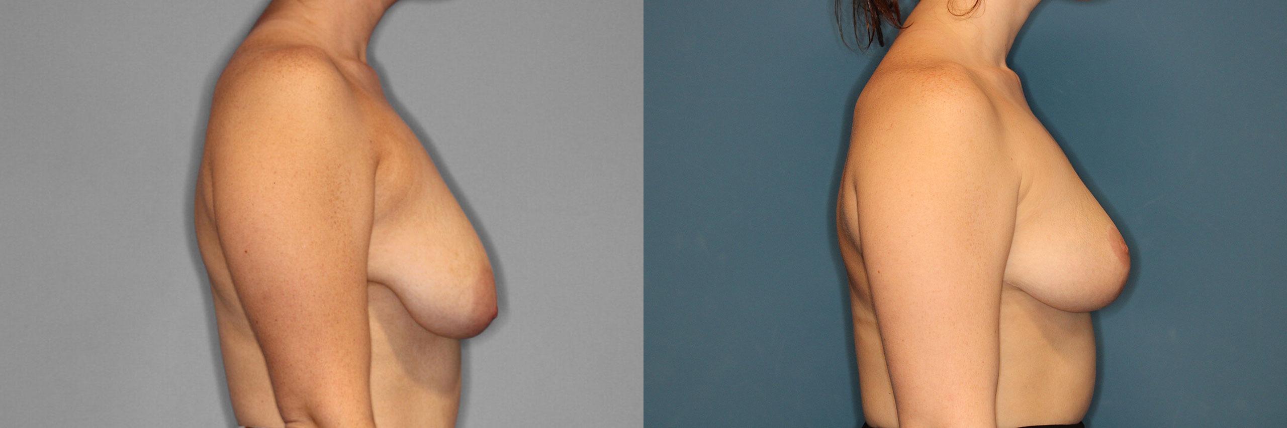Breast Reduction Before and After photo by Dr. Abigail Rodriguez in Houston, TX