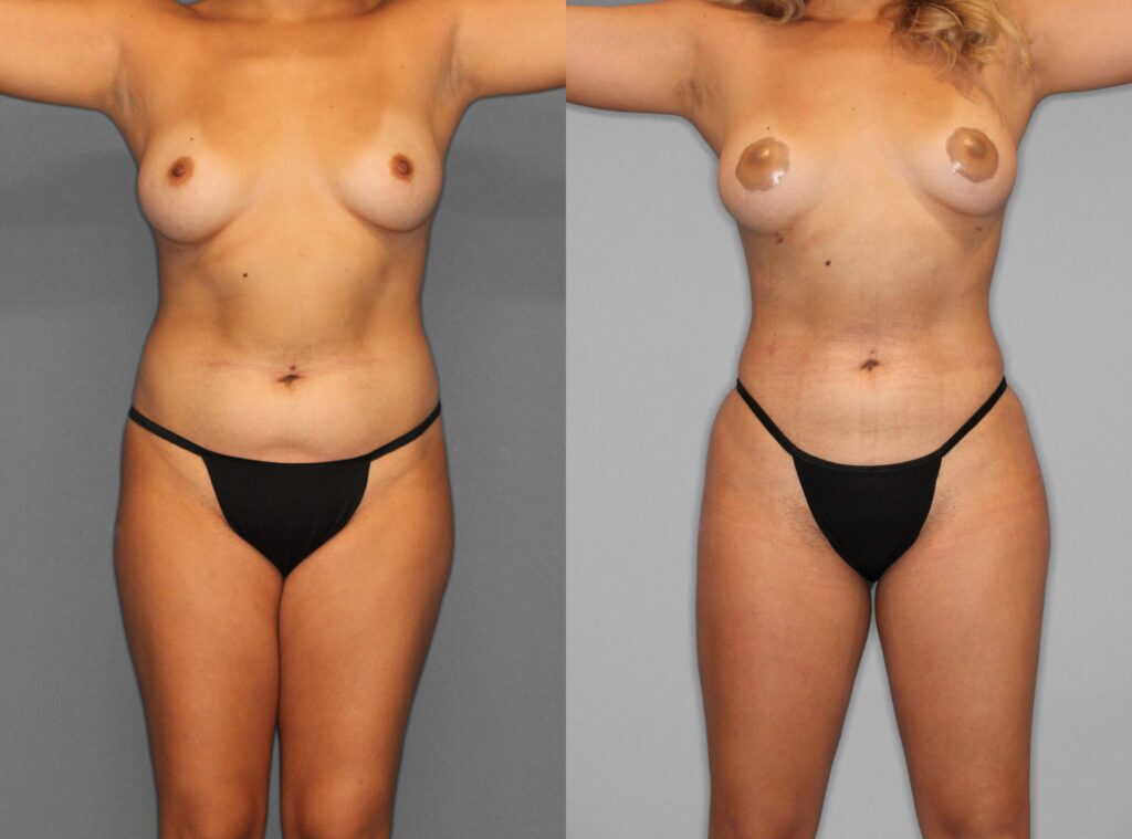 Fat Grafting:Liposuction Before and After photo by Dr. Abigail Rodriguez in Houston, TX
