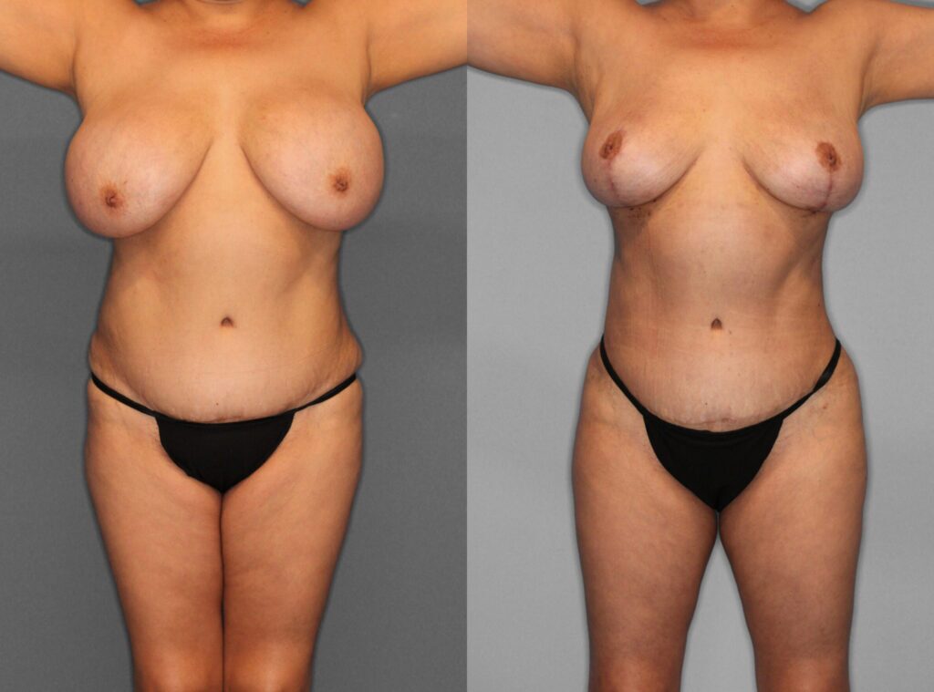 Fat Grafting:Liposuction Before and After photo by Dr. Abigail Rodriguez in Houston, TX
