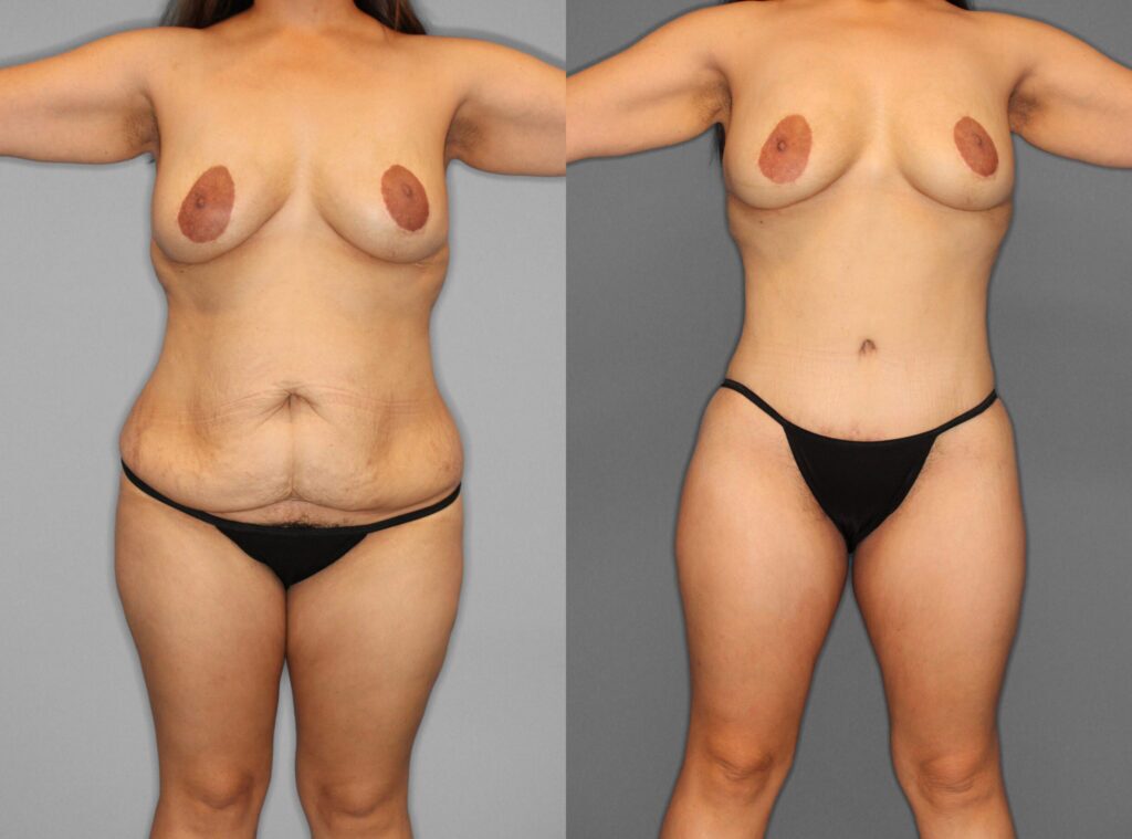 Liposuction:Tummy Tuck Before and After photo by Dr. Abigail Rodriguez in Houston, TX