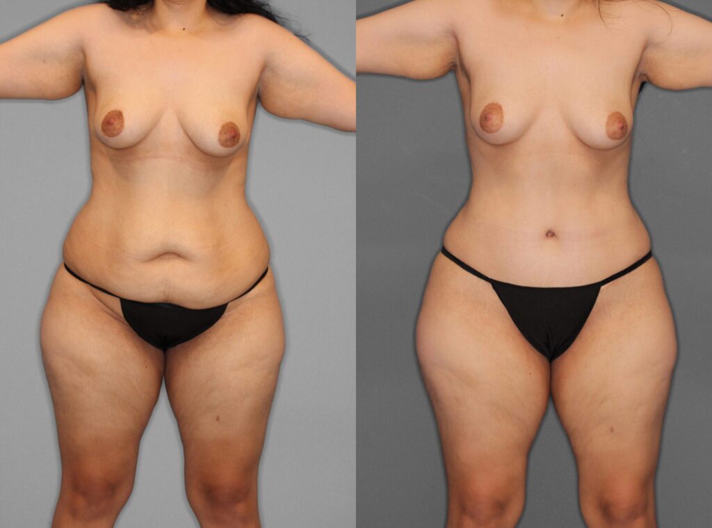 Liposuction:Tummy Tuck Before and After photo by Dr. Abigail Rodriguez in Houston, TX