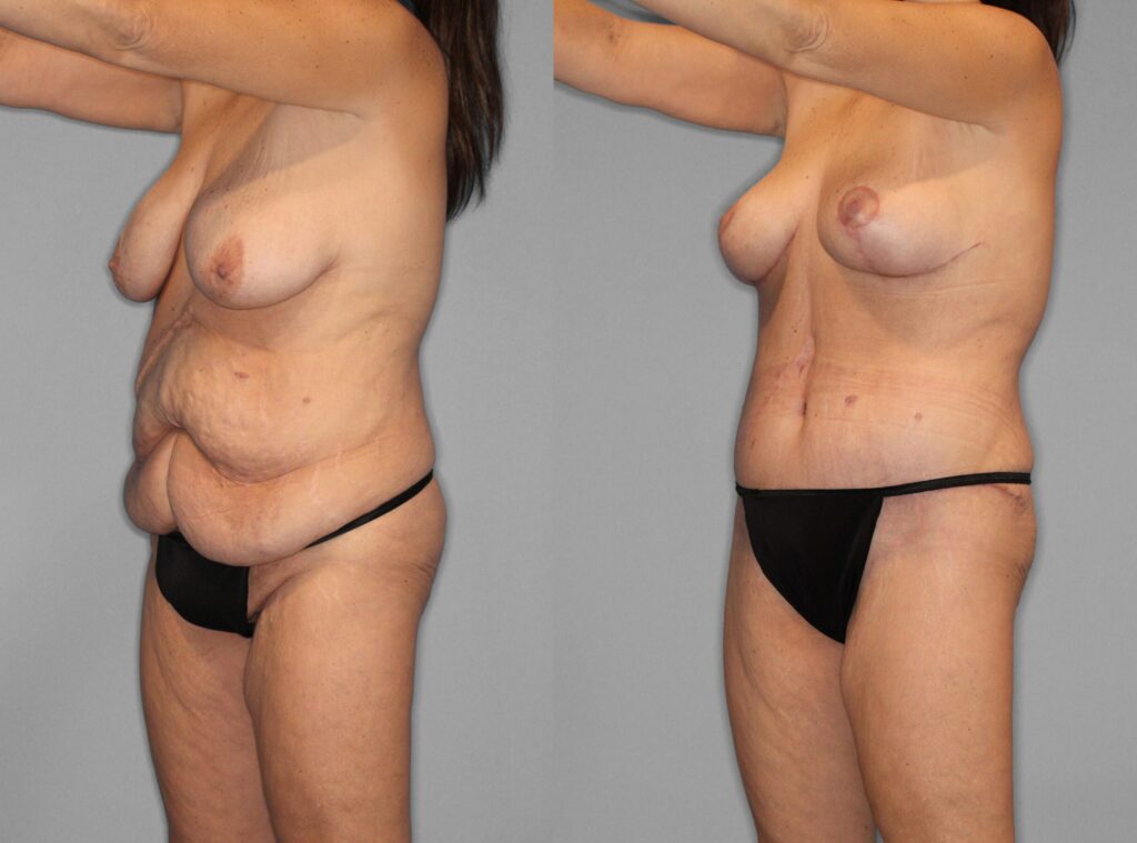 Liposuction:Tummy Tuck Before and After photo by Dr. Abigail Rodriguez in Houston, TX
