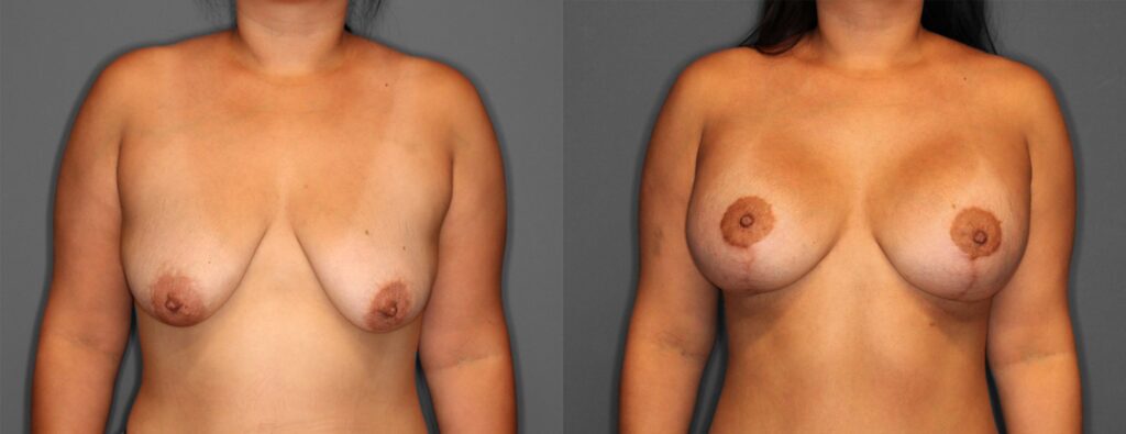 Breast Lift + Augmentation Before and After photo by Dr. Abigail Rodriguez in Houston, TX