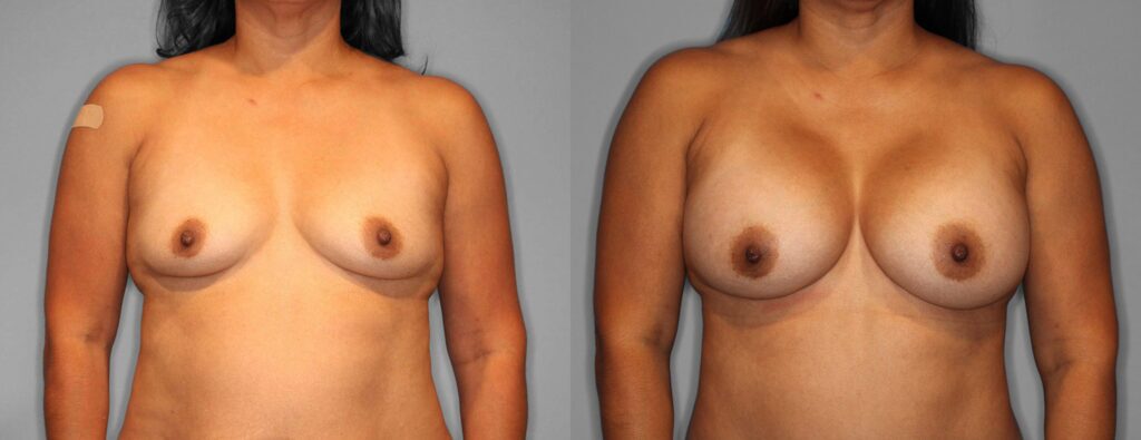 Breast Lift + Augmentation Before and After photo by Dr. Abigail Rodriguez in Houston, TX