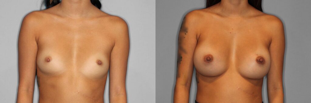 Breast Augmentation Before and After photo by Dr. Abigail Rodriguez in Houston, TX