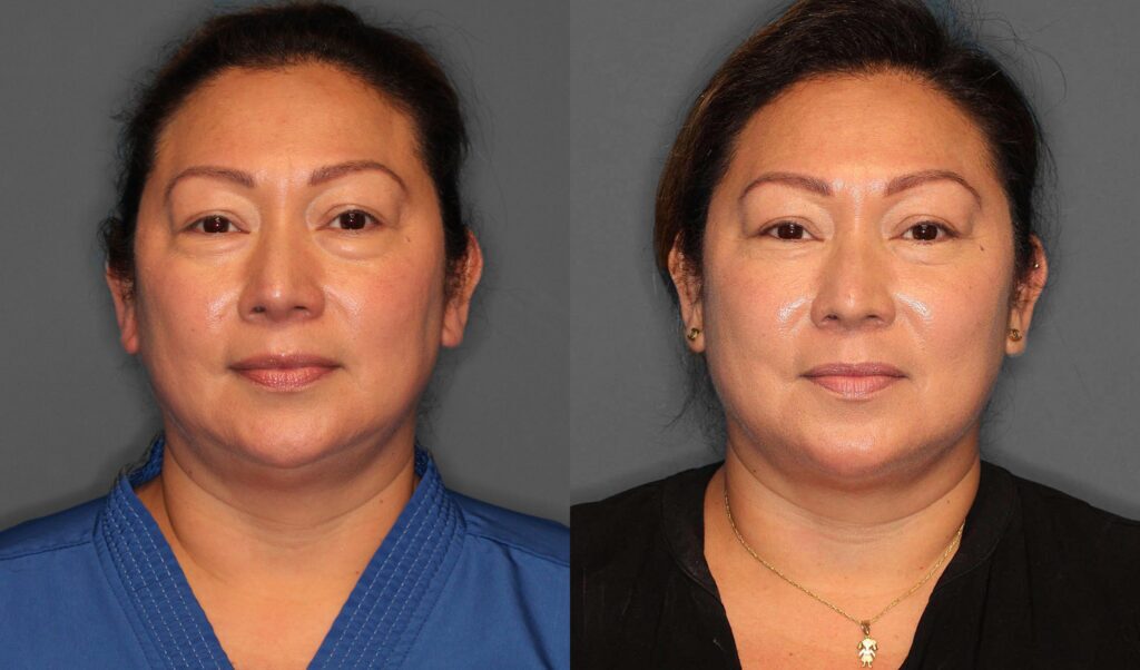 Lower Blepharoplasty Before and After photo by Dr. Abigail Rodriguez in Houston, TX