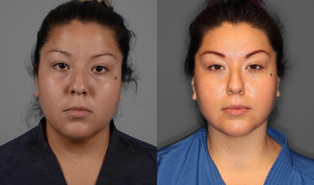 Neck Liposuction Before and After photo by Dr. Abigail Rodriguez in Houston, TX