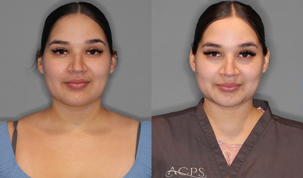Neck Liposuction Before and After photo by Dr. Abigail Rodriguez in Houston, TX