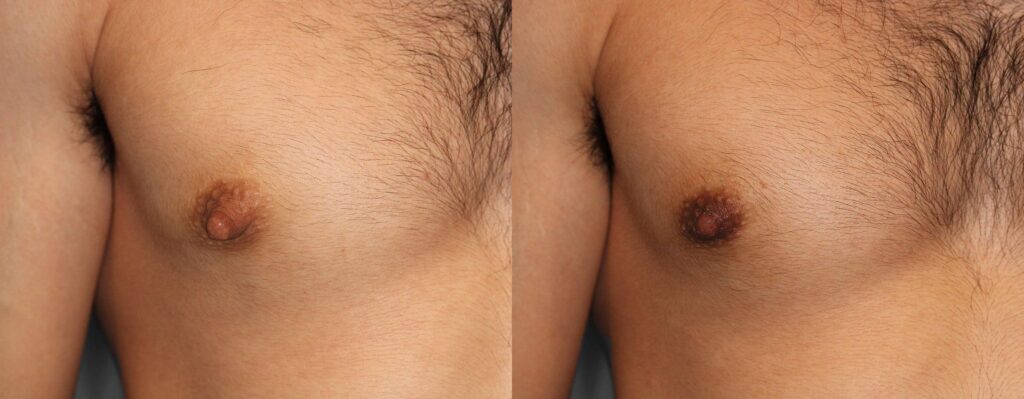 Nipple Reduction Before and After photo by Dr. Abigail Rodriguez in Houston, TX