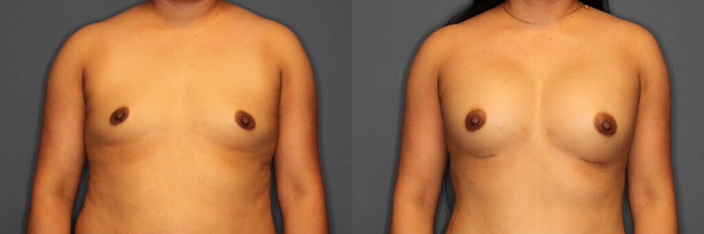 Brast Augmentation Before and After photo by Dr. Abigail Rodriguez in Houston, TX