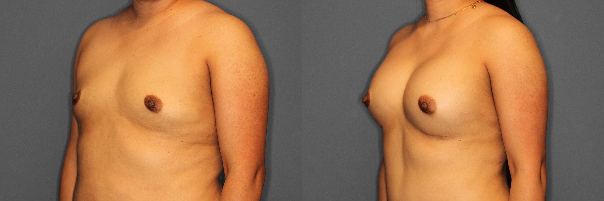 Brast Augmentation Before and After photo by Dr. Abigail Rodriguez in Houston, TX
