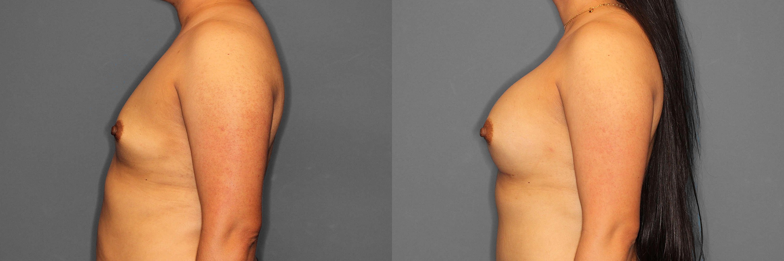 Brast Augmentation Before and After photo by Dr. Abigail Rodriguez in Houston, TX