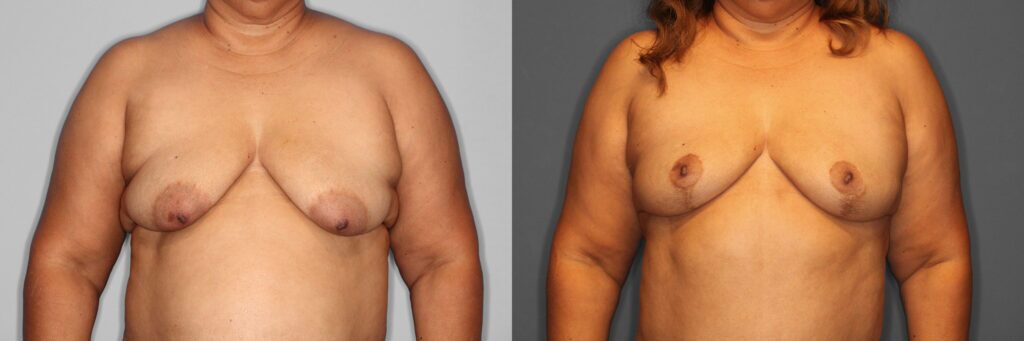 Breast Lift Before and After photo by Dr. Abigail Rodriguez in Houston, TX