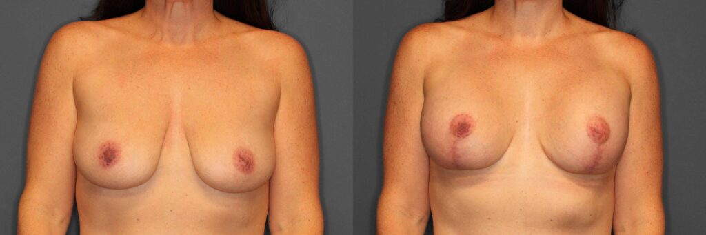 Breast Lift+Augmentation Before and After photo by Dr. Abigail Rodriguez in Houston, TX