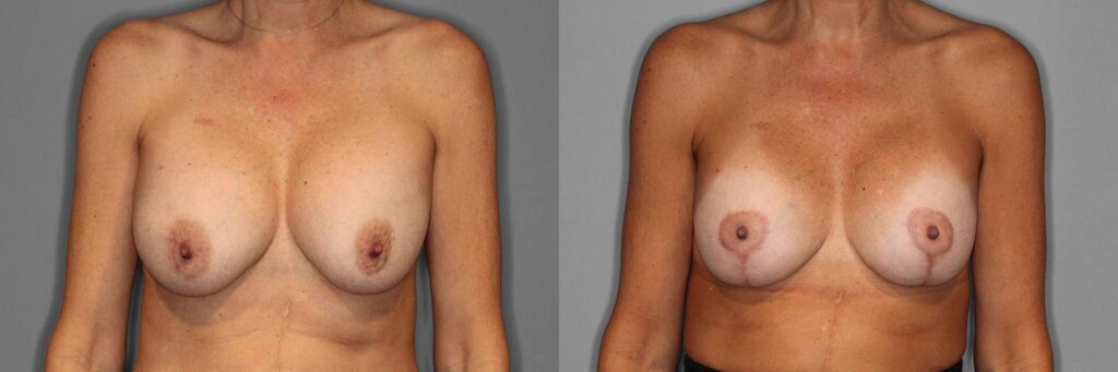 Breast Revision Before and After photo by Dr. Abigail Rodriguez in Houston, TX