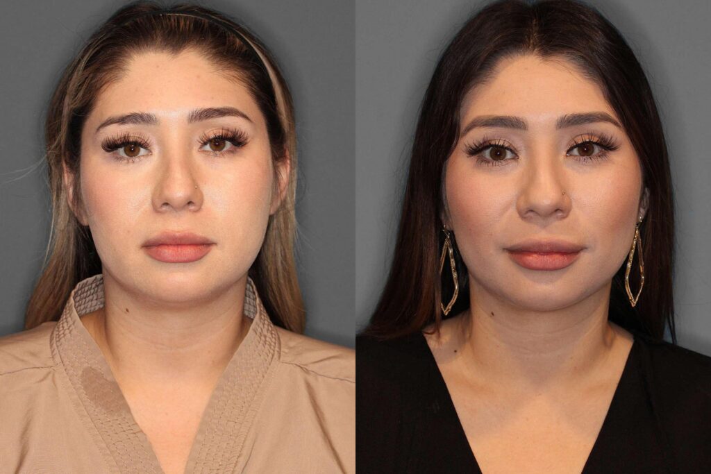 Buccal Fat Pad Removal Before and After photo by Dr. Abigail Rodriguez in Houston, TX