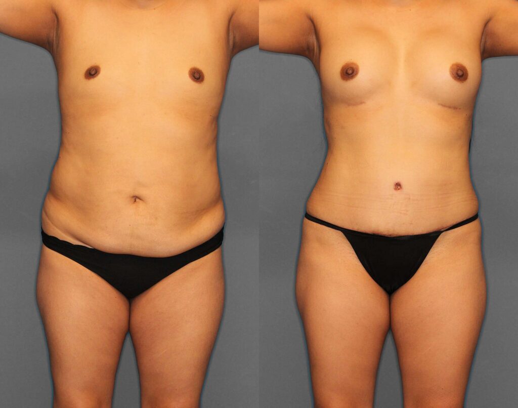 Tummy Tuck:Lipo:BBL Before and After photo by Dr. Abigail Rodriguez in Houston, TX