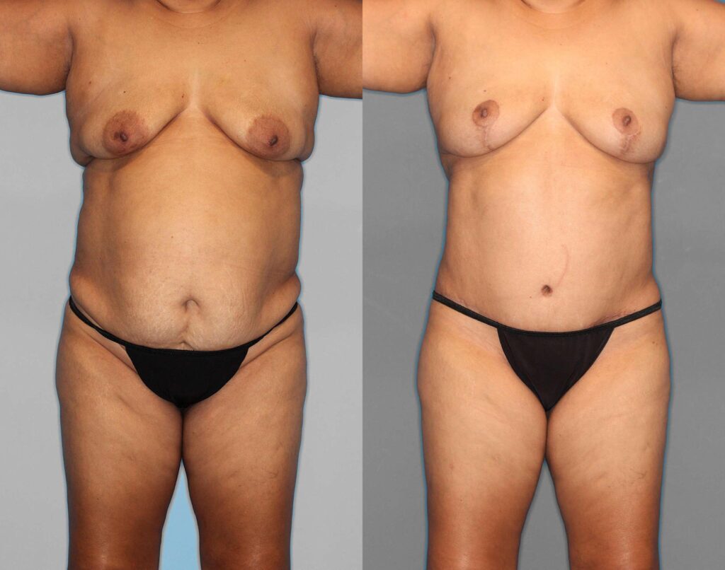 Tummy Tuck:Lipo:Hernia Repair Before and After photo by Dr. Abigail Rodriguez in Houston, TX