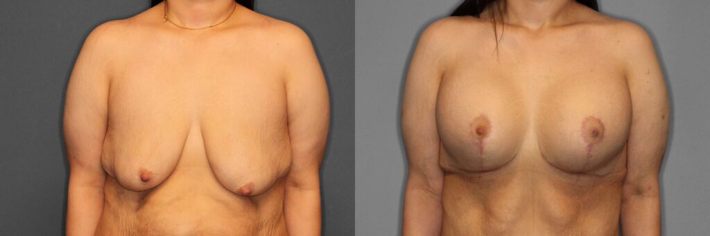 Breast Augmentation:Lift Before and After photo by Dr. Abigail Rodriguez in Houston, TX