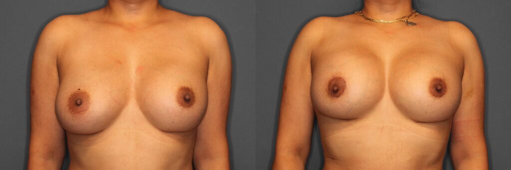 Breast Revision Before and After photo by Dr. Abigail Rodriguez in Houston, TX