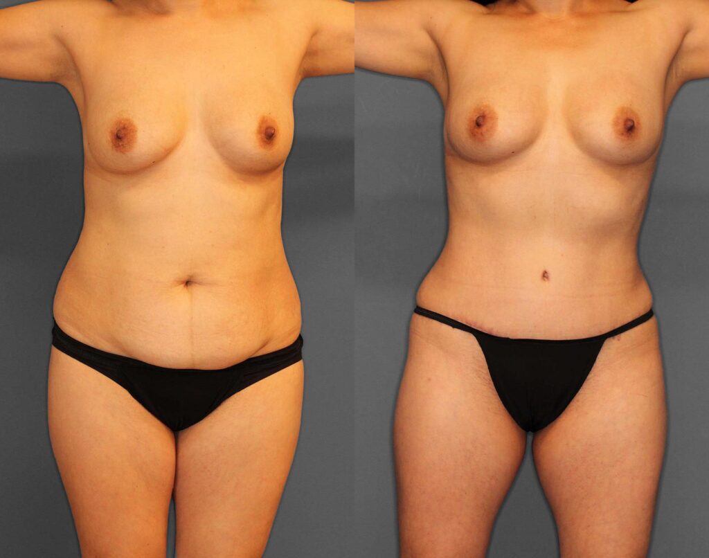 Liposuction:Tummy Tuck Before and After photo by Dr. Abigail Rodriguez in Houston, TX