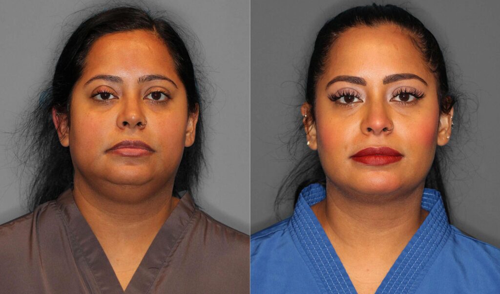 Neck Liposuction:Buccal Fat Before and After photo by Dr. Abigail Rodriguez in Houston, TX