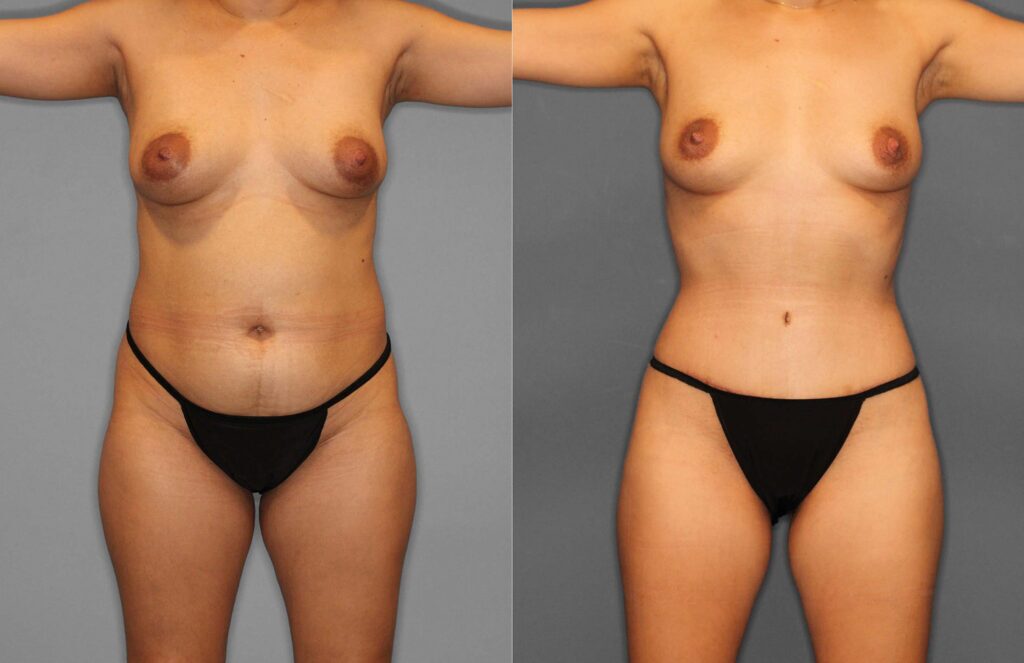 Tummy Tuck:Liposuction Before and After photo by Dr. Abigail Rodriguez in Houston, TX