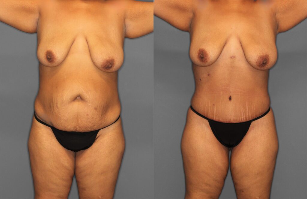 Tummy Tuck:Liposuction Before and After photo by Dr. Abigail Rodriguez in Houston, TX