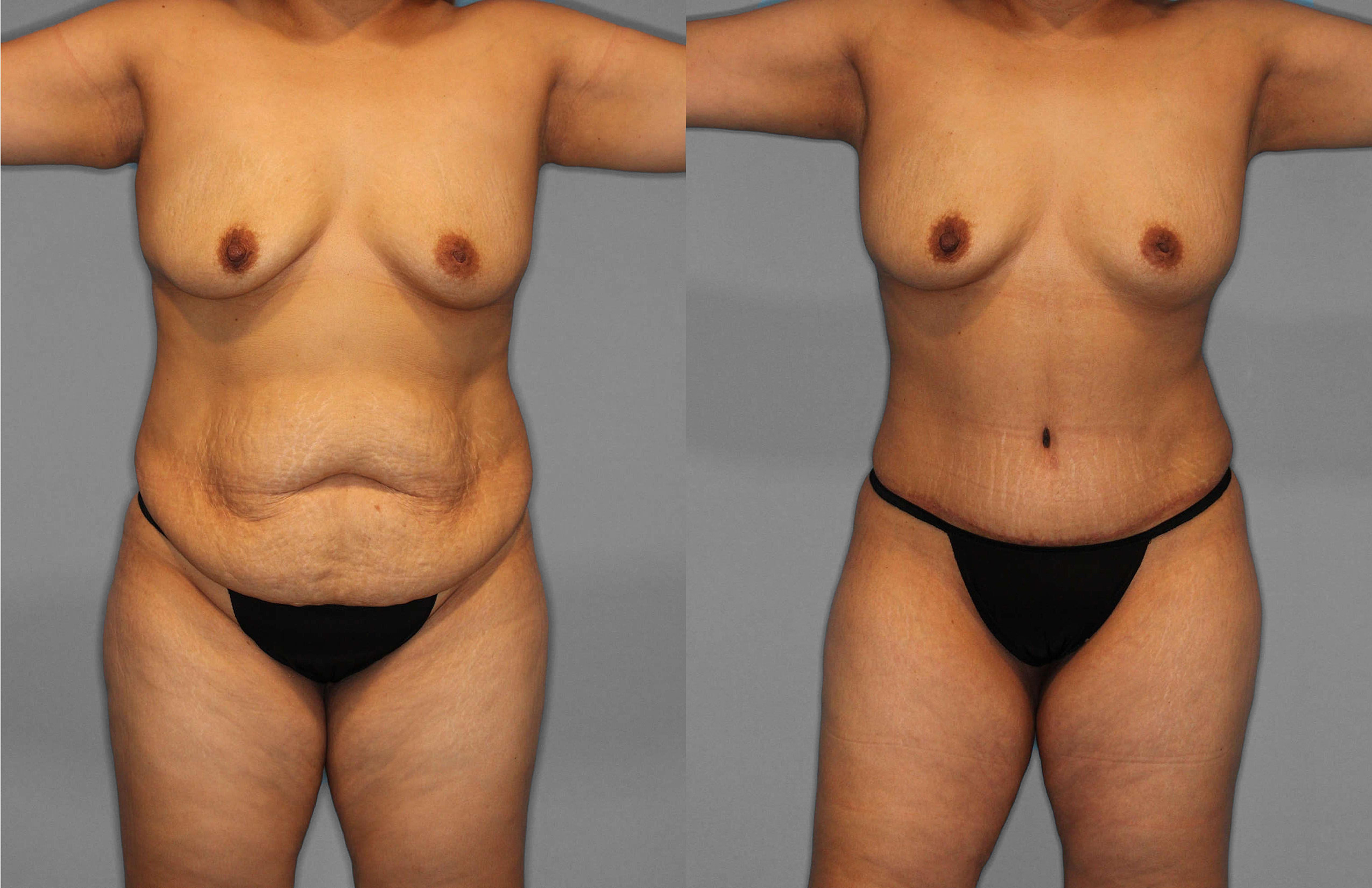 Tummy Tuck:Liposuction Before and After photo by Dr. Abigail Rodriguez in Houston, TX