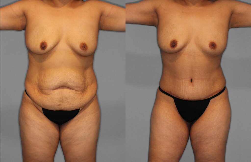 Tummy Tuck:Liposuction Before and After photo by Dr. Abigail Rodriguez in Houston, TX