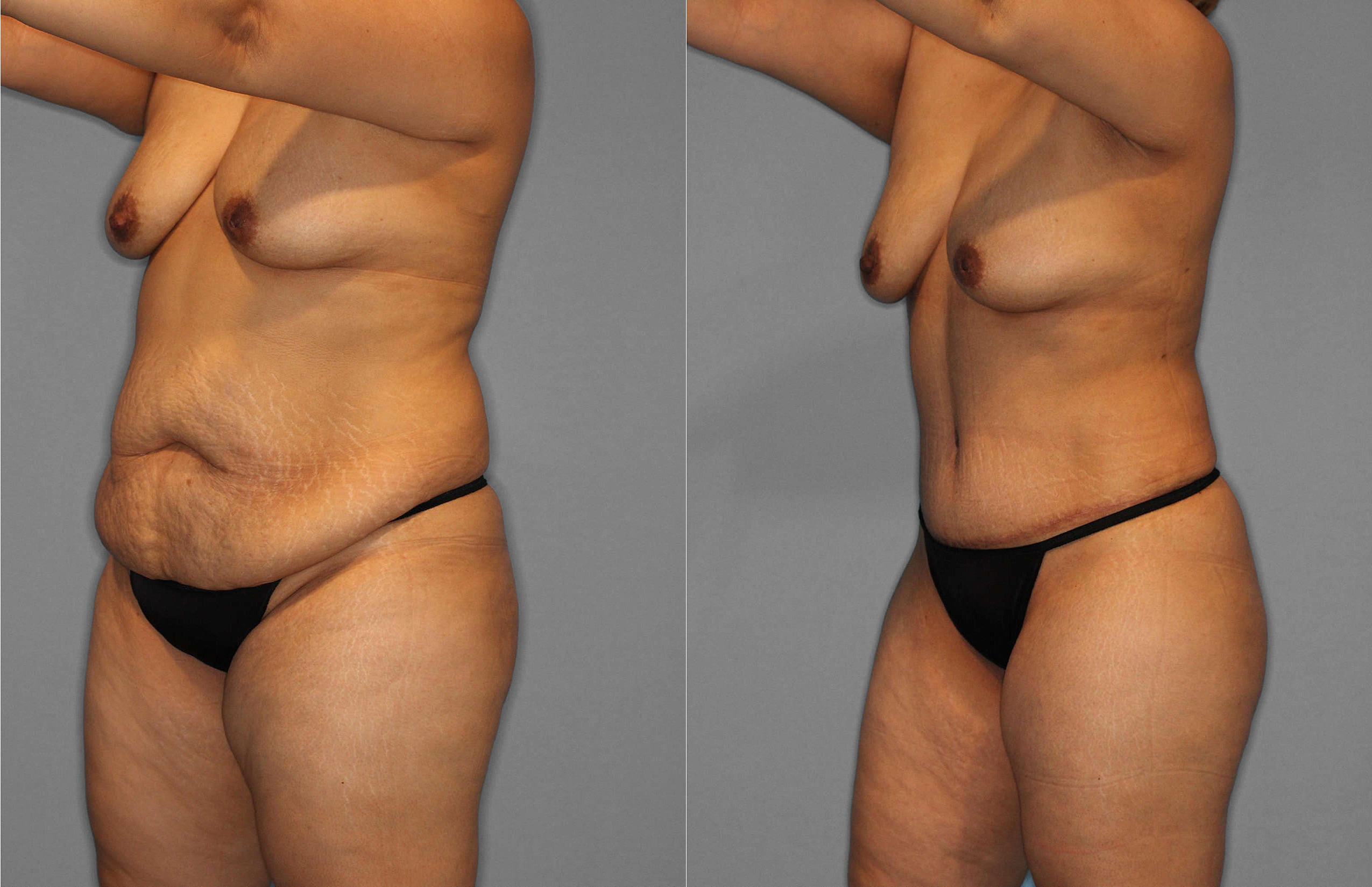 Tummy Tuck:Liposuction Before and After photo by Dr. Abigail Rodriguez in Houston, TX