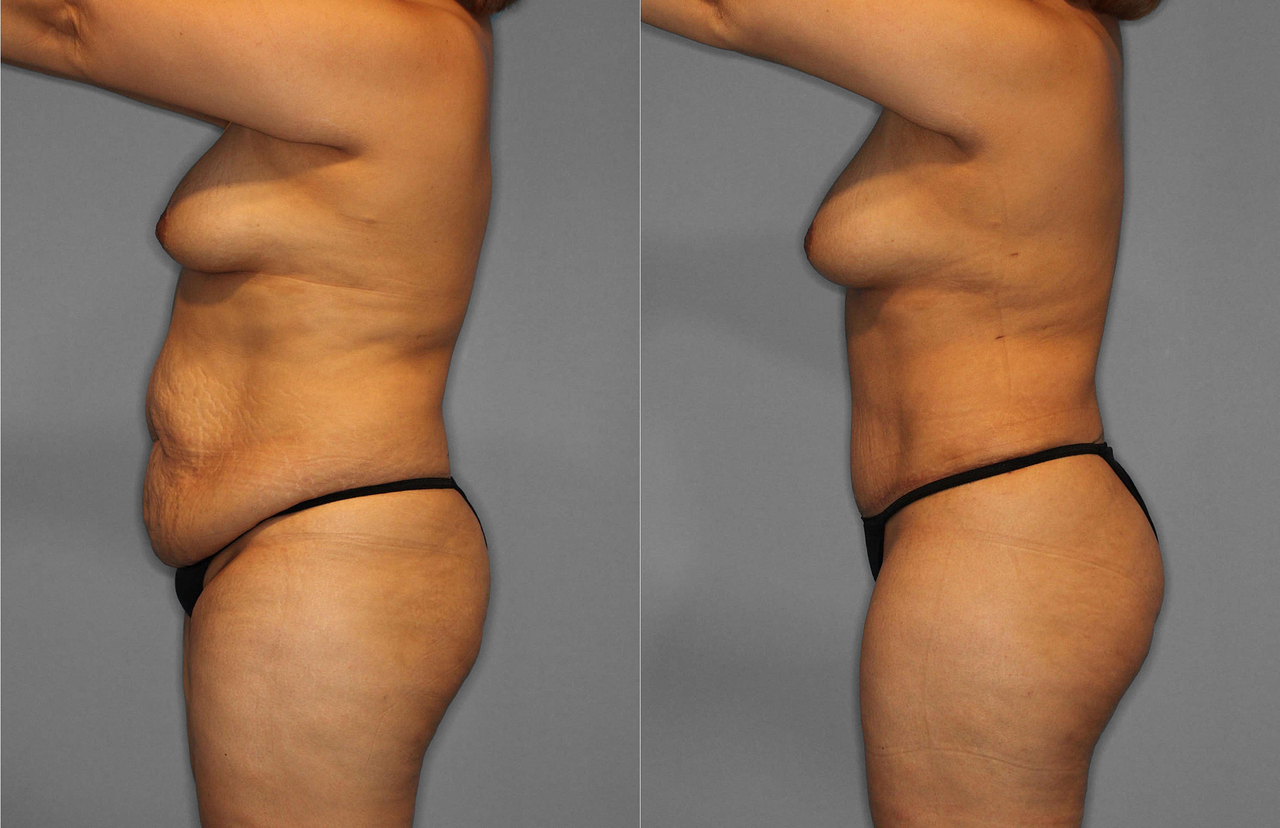 Tummy Tuck:Liposuction Before and After photo by Dr. Abigail Rodriguez in Houston, TX