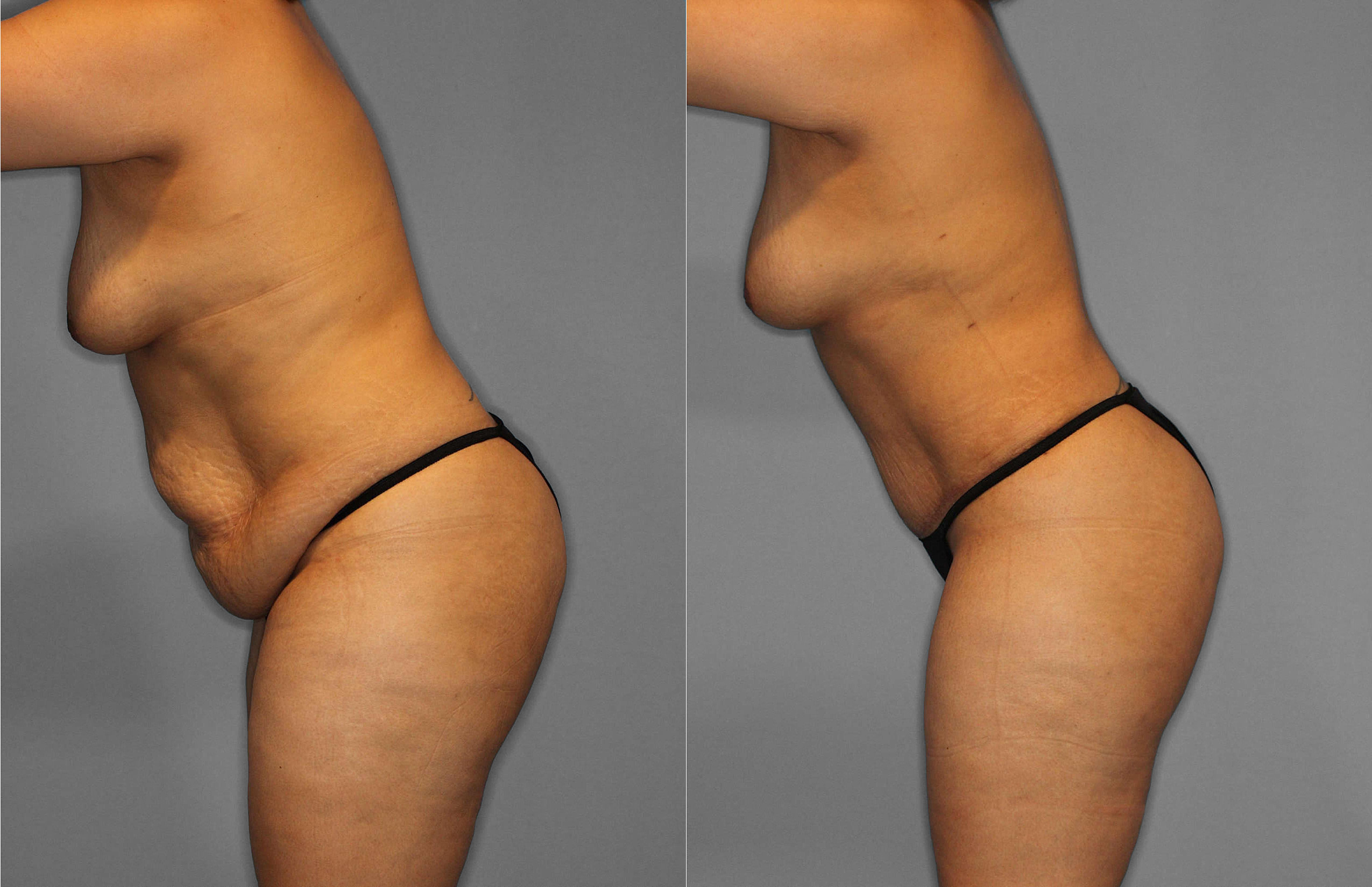Tummy Tuck:Liposuction Before and After photo by Dr. Abigail Rodriguez in Houston, TX