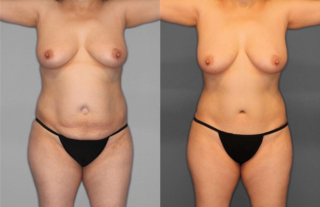 Tummy Tuck:Liposuction:Hernia Before and After photo by Dr. Abigail Rodriguez in Houston, TX