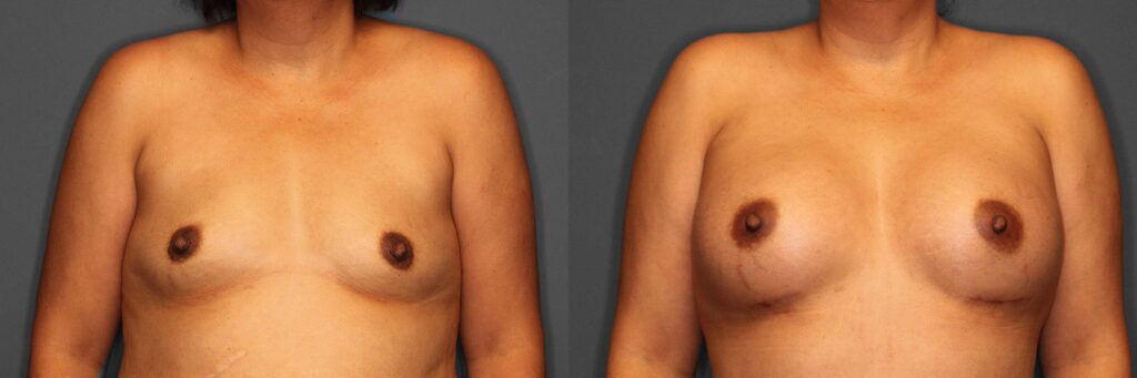 Breast Augmentation Before and After photo by Dr. Abigail Rodriguez in Houston, TX