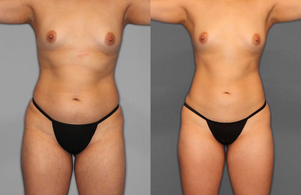 Liposuction Before and After photo by Dr. Abigail Rodriguez in Houston, TX