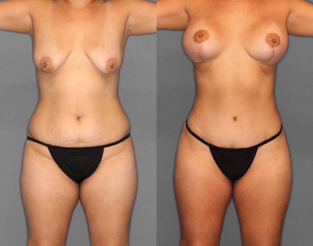 Tummy Tuck Before and After photo by Dr. Abigail Rodriguez in Houston, TX