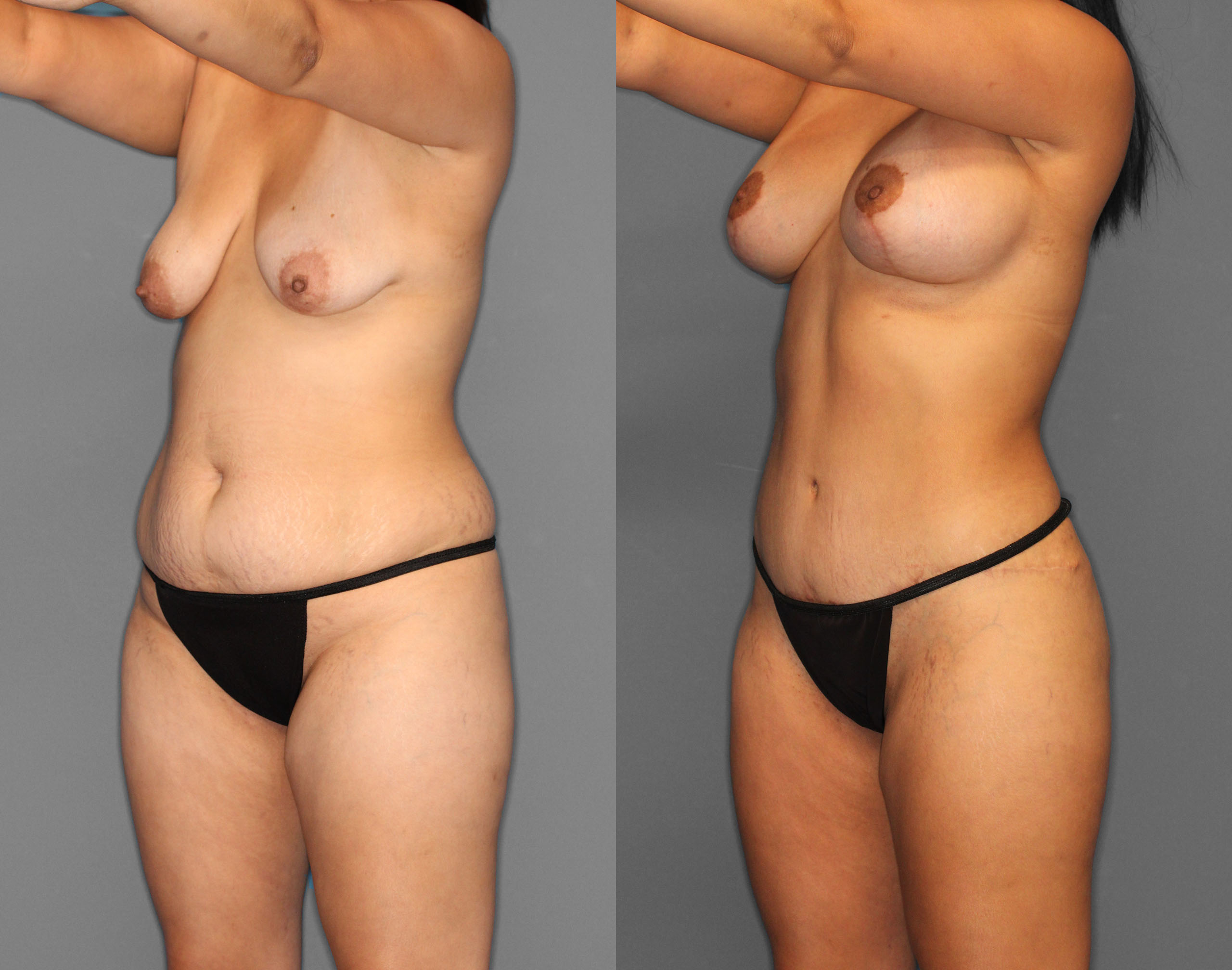 Tummy Tuck Before and After photo by Dr. Abigail Rodriguez in Houston, TX