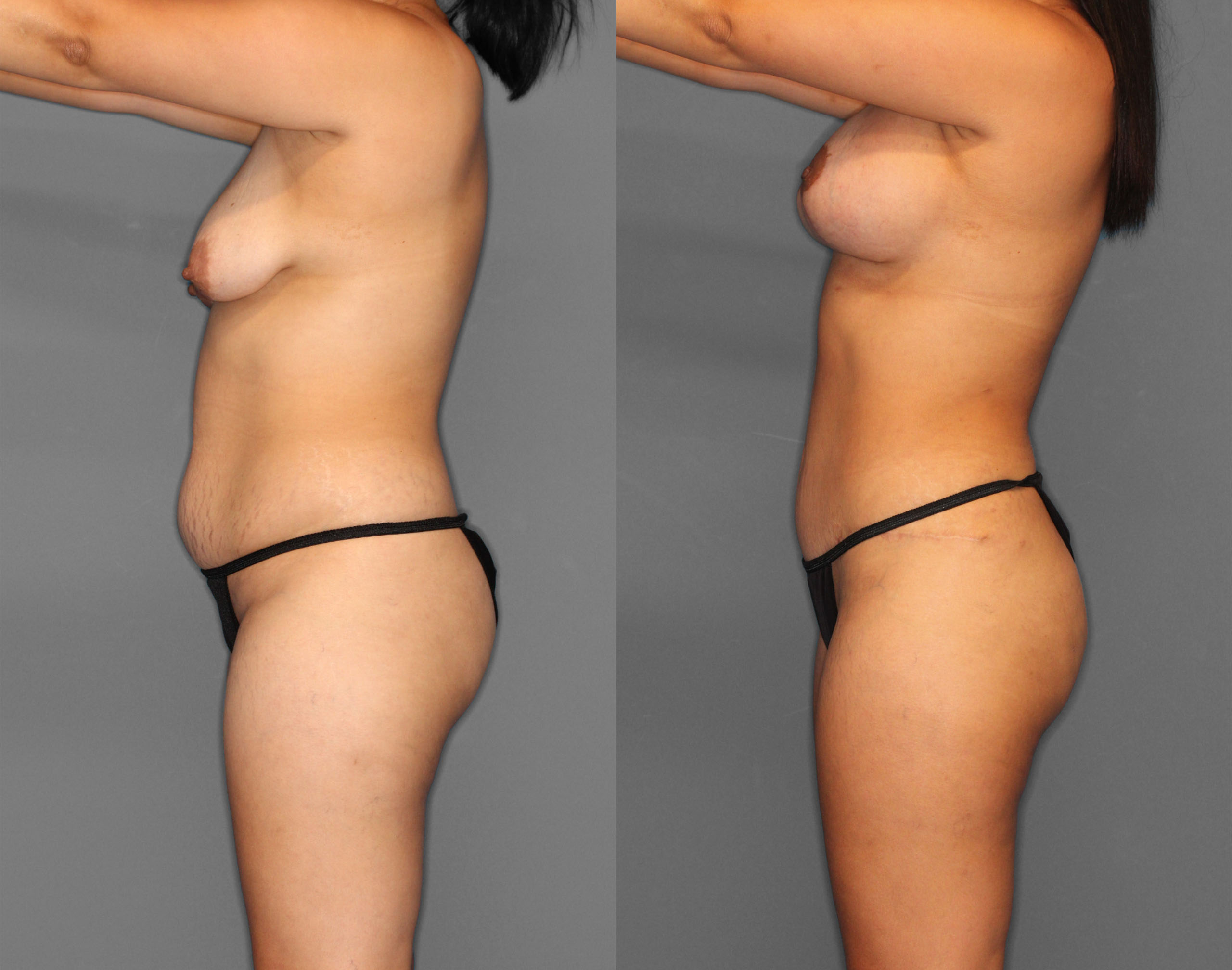 Tummy Tuck Before and After photo by Dr. Abigail Rodriguez in Houston, TX