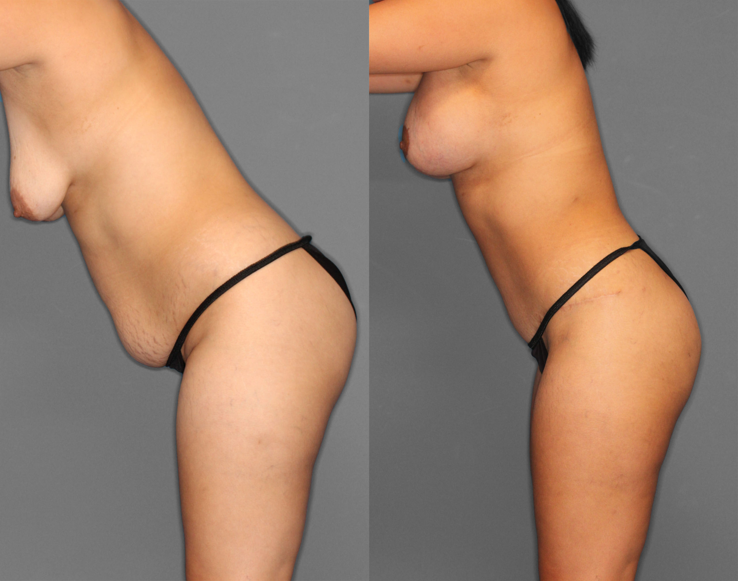 Tummy Tuck Before and After photo by Dr. Abigail Rodriguez in Houston, TX
