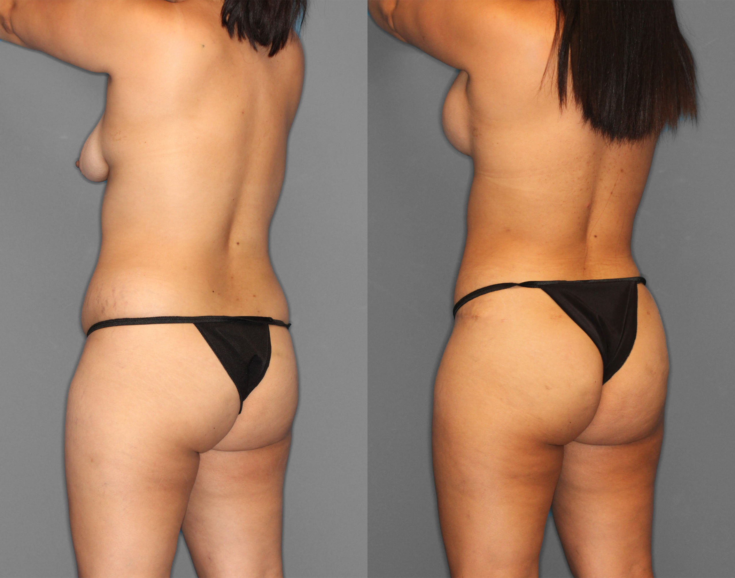 Tummy Tuck Before and After photo by Dr. Abigail Rodriguez in Houston, TX